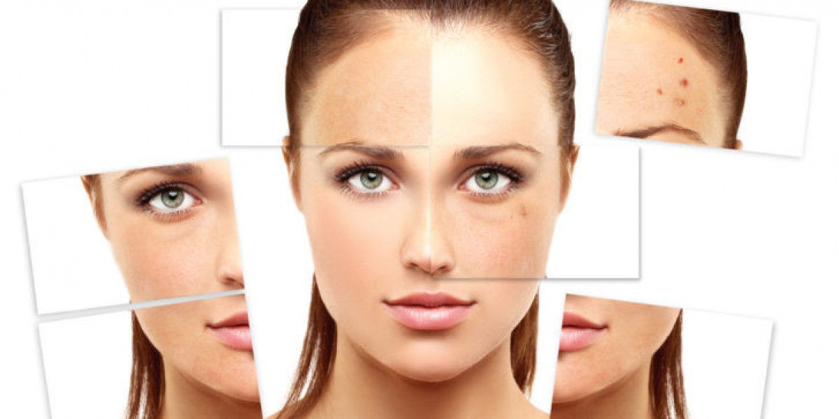 Melasma Treatment: Can It Really Be Fully Reversed?