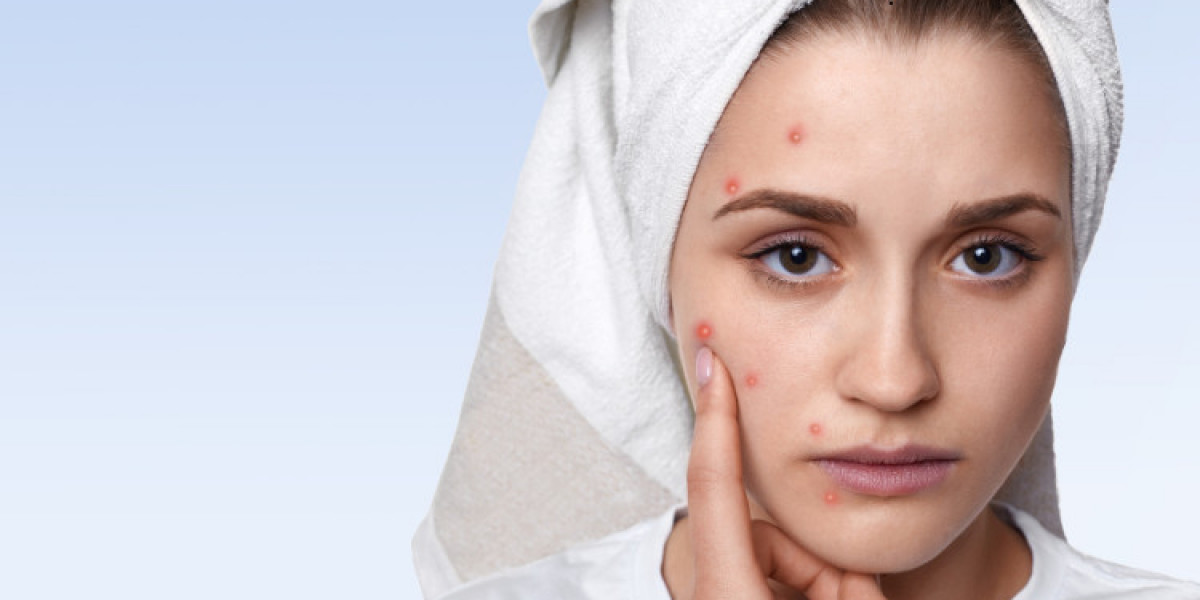 Acne Treatment in Arlington: Clearer Skin Awaits