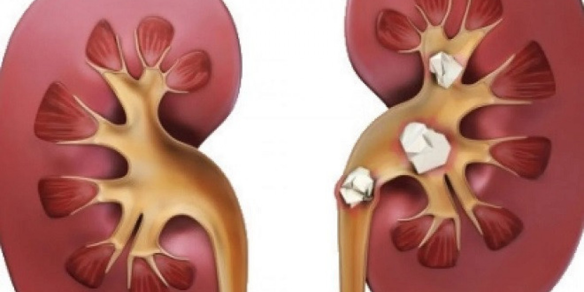 Effective Ayurvedic Treatment For Kidney Stone: Say Goodbye to Pain and Discomfort