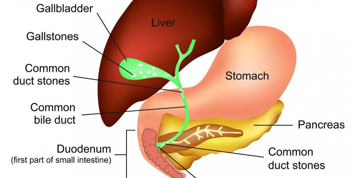 Discover the Best Laser Treatment for Gallstones Near Me