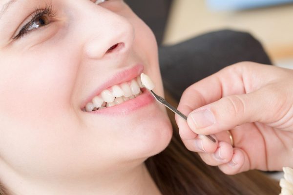 Resin Dental Veneers - Adelaide Cosmetic Dentistry